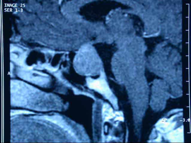 Adenoma de Hipófisis: Si mi tumor es benigno, ¿por qué tengo que operarme?  - Unidad de Neurocirugía RGS