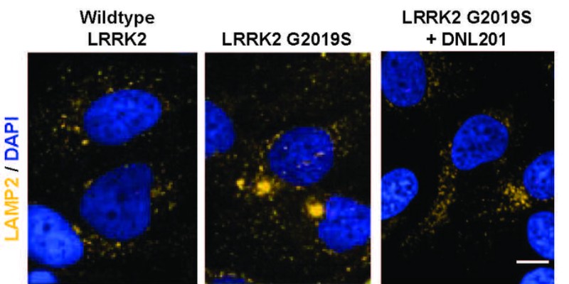 Células humanas que expresan LRRK2, a las 72 horas del tratamiento; la estructura de los lisosomas se marca en amarillo. Foto: STM