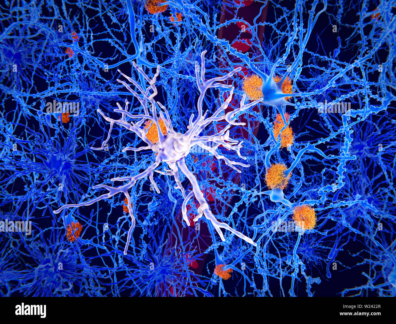 Células microglia y amiloide en la enfermedad de Alzheimer. Ilustración de placas amiloideas (naranja) y células microglia (luz púrpura, centro) entre cerebro ce Fotografía de stock - Alamy