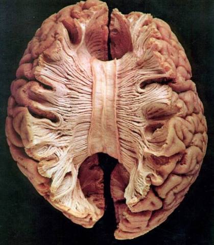 Cuerpo calloso del cerebro: estructura, funciones y lesiones