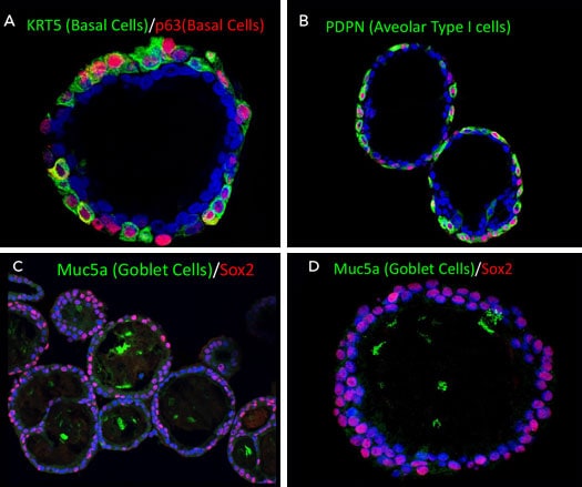 Human lung organoids grown in Cultrex UltiMatrix RGF BME and stained for Cytokeratin 5, p63, Podoplanin, Muc5a, and SOX2.