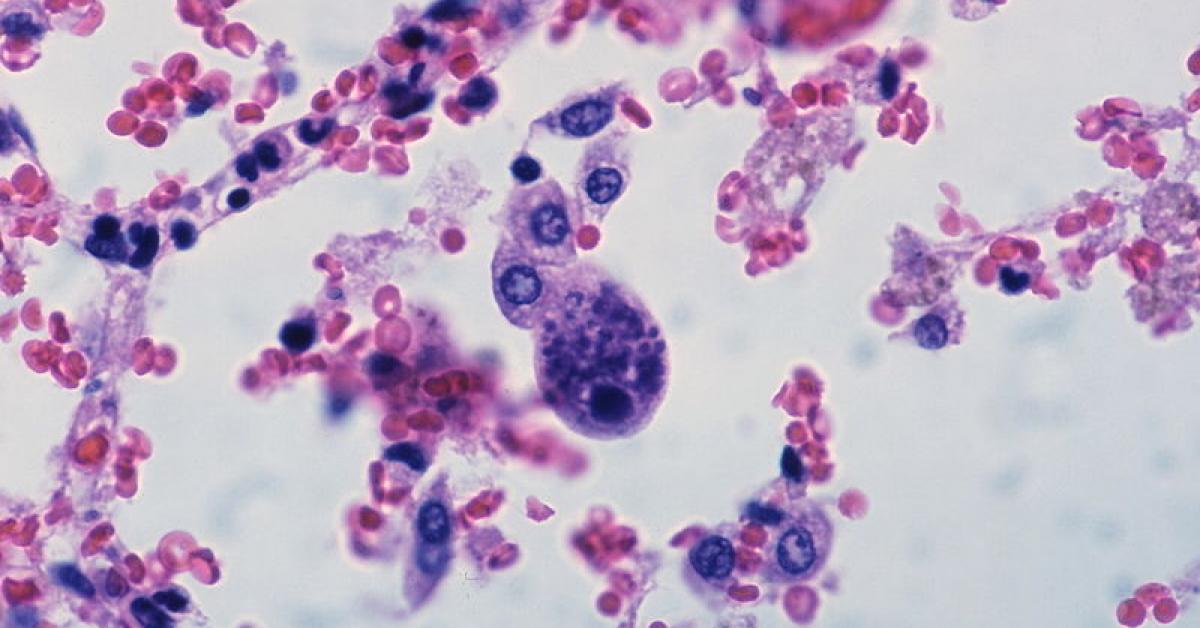 Infección congénita por citomegalovirus: síntomas, diganóstico y  tratamiento | Faros HSJBCN