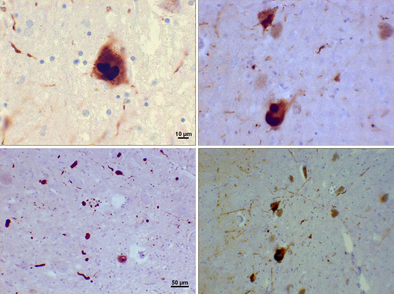 Las fotomicrografías de regiones de la sustancia negra de este paciente con Parkinson muestran cuerpos de Lewy y neuritas de Lewy en varios aumentos. Los paneles superiores muestran imágenes a 60x de las inclusiones intraneuronales de alfa-sinucleína agregadas para formar cuerpos de Lewy. Los paneles inferiores son imágenes a 20x que muestran neuritas de Lewy en forma de filamentos y cuerpos de Lewy redondeados de varios tamaños. En el fondo se aprecian células de la sustancia negra cargadas de neuromelanina. Tinciones utilizadas: anticuerpo monoclonal de ratón anti-alfa-sinucleína; contratinción de hematoxilina de Mayer.