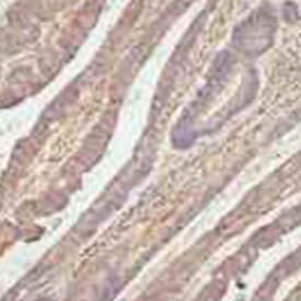 Tinción inmunohistoquímica del tejido del adenocarcinoma de colon con anticuerpo monoclonal anti-TLR4 de ratón.