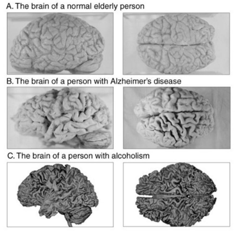 El Alcohol Inflama Al Cerebro Enriquerubio Net