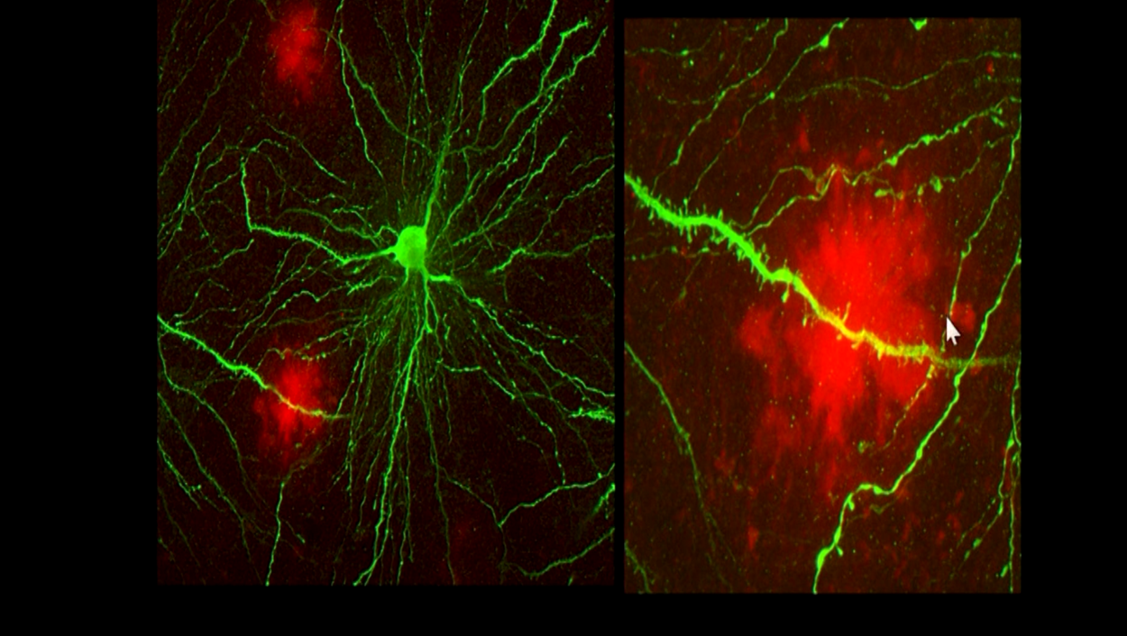 LA PROTEINA BETA AMILOIDE ALZHEIMER Y CATARATAS – Enriquerubio.net