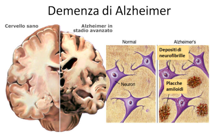 Β-AMILOIDE Y ALZHEIMER – Enriquerubio.net